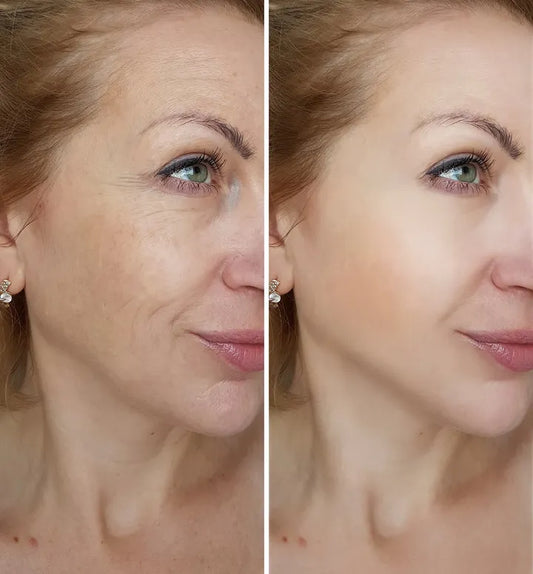 How to Get Rid of Fine Lines Without Botox – The Natural Approach That Works